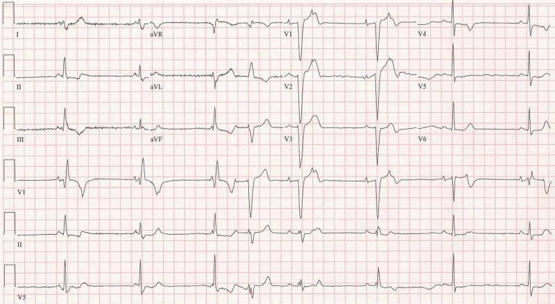 ekg