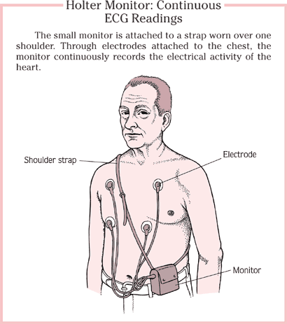 holter monitoring