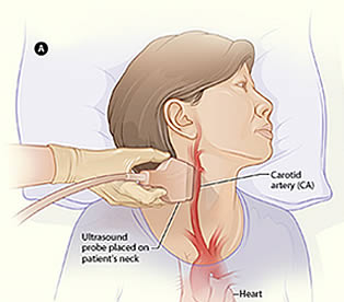 doppler ultrasound